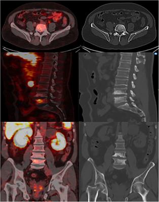 Case report: positive pitfalls of PSMA PET/CT: diagnostic challenges in degenerative bone lesions including MODIC type 1